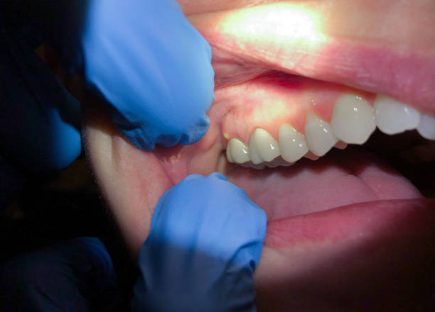 Best Chipped Tooth Repair Near Me  in Algona, IA